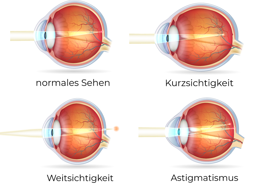 Fehlsichtigkeiten des Auges